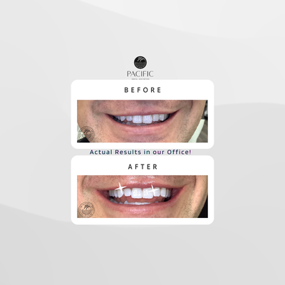 Zoom Whitening Results - This includes actual results with real patients from our office, who have had great success with their whitening. Zoom Whitening Results - This includes actual results with real patients from our office, who have had great success with their whitening.