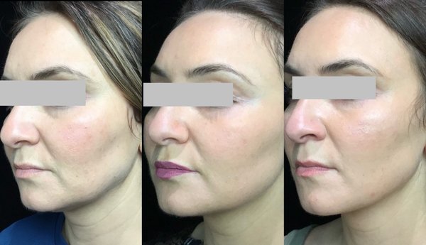 Ultherapy - Ultherapy uses ultrasound to target the SMAS layer, generate collagen to lift the eyebrows, neck and chin. People will see their faces more snatched and defined after the treatment. This is one of the most popular treatments we have at our practice. Ultherapy - Ultherapy uses ultrasound to target the SMAS layer, generate collagen to lift the eyebrows, neck and chin. People will see their faces more snatched and defined after the treatment. This is one of the most popular treatments we have at our practice.