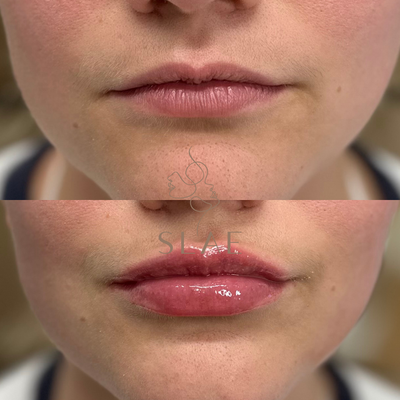 Lip Filler - Dermal fillers are gel-like substances, such as Hyaluronic Acid, injected under the skin to replenish lost volume, reduce lines, soften creases, or improve facial contours. These fillers are commonly applied in various areas, including Cheeks, Chin, Lips, Jawline, Smile Lines, and Temples. SLAE Aesthetics + Wellness exclusively utilizes FDA-approved fillers. Lip Filler - Dermal fillers are gel-like substances, such as Hyaluronic Acid, injected under the skin to replenish lost volume, reduce lines, soften creases, or improve facial contours. These fillers are commonly applied in various areas, including Cheeks, Chin, Lips, Jawline, Smile Lines, and Temples. SLAE Aesthetics + Wellness exclusively utilizes FDA-approved fillers.