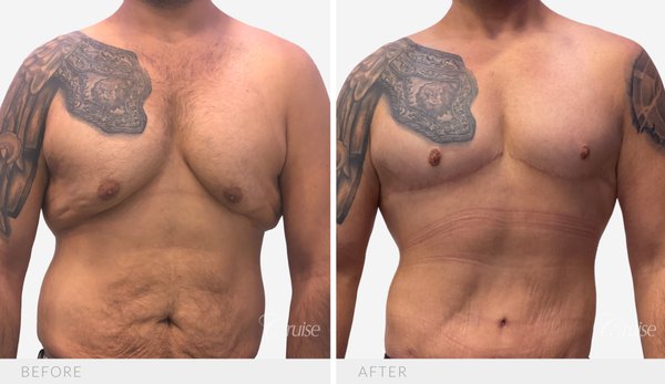 Type 6 Gynecomastia After 170-Lb Weight Loss — Circumferential Chest Lift - After losing more than 170 pounds, this 36-year-old patient from Rialto, California achieved an incredible weight-loss transformation — but was left with severe Type 6 gynecomastia, excess chest skin, and significant skin laxity extending around the sides of his chest. Like many men after massive weight loss, no amount of diet or exercise could eliminate the loose skin or restore a masculine chest contour.
Dr. Joseph Cruise performed a circumferential chest lift with free nipple grafts and axillary liposuction to remove the excess skin and reshape the chest. The chest photographs shown were taken 14 months after surgery, demonstrating a flat, natural, masculine contour with well-healed incisions and properly positioned nipple grafts.
After seeing his results, he returned to complete the second stage of his transformation: a circumferential tummy tuck with pubic lift, flank liposuction, and fat transfer to the buttocks (345 cc per side). The abdominal photographs show his results 6 months after body lift surgery.
In his words: "After losing more than 170 pounds, I never imagined I could have a normal-looking male chest. Dr. Cruise transformed what I thought was an impossible case. For the first time in my life, I could take my shirt off without embarrassment. My results exceeded every expectation, and after seeing what was possible, I returned for a circumferential tummy tuck to complete my transformation. Everything was absolutely worth it." — Verified Patient ★★★★★
Procedure details: Type 6 gynecomastia (after massive weight loss) • Circumferential chest lift with free nipple grafts • Axillary liposuction • Circumferential tummy tuck with pubic lift • Flank liposuction • Fat transfer to buttocks • Chest results shown at 14 months; abdominal results at 6 months.
Dr. Cruise is one of the nation's most experienced gynecomastia surgeons and developed a widely used gynecomastia classification system. Every treatment plan is tailored to the patient's gynecomastia type, skin quality, and goals. Type 6 Gynecomastia After 170-Lb Weight Loss — Circumferential Chest Lift - After losing more than 170 pounds, this 36-year-old patient from Rialto, California achieved an incredible weight-loss transformation — but was left with severe Type 6 gynecomastia, excess chest skin, and significant skin laxity extending around the sides of his chest. Like many men after massive weight loss, no amount of diet or exercise could eliminate the loose skin or restore a masculine chest contour.
Dr. Joseph Cruise performed a circumferential chest lift with free nipple grafts and axillary liposuction to remove the excess skin and reshape the chest. The chest photographs shown were taken 14 months after surgery, demonstrating a flat, natural, masculine contour with well-healed incisions and properly positioned nipple grafts.
After seeing his results, he returned to complete the second stage of his transformation: a circumferential tummy tuck with pubic lift, flank liposuction, and fat transfer to the buttocks (345 cc per side). The abdominal photographs show his results 6 months after body lift surgery.
In his words: "After losing more than 170 pounds, I never imagined I could have a normal-looking male chest. Dr. Cruise transformed what I thought was an impossible case. For the first time in my life, I could take my shirt off without embarrassment. My results exceeded every expectation, and after seeing what was possible, I returned for a circumferential tummy tuck to complete my transformation. Everything was absolutely worth it." — Verified Patient ★★★★★
Procedure details: Type 6 gynecomastia (after massive weight loss) • Circumferential chest lift with free nipple grafts • Axillary liposuction • Circumferential tummy tuck with pubic lift • Flank liposuction • Fat transfer to buttocks • Chest results shown at 14 months; abdominal results at 6 months.
Dr. Cruise is one of the nation's most experienced gynecomastia surgeons and developed a widely used gynecomastia classification system. Every treatment plan is tailored to the patient's gynecomastia type, skin quality, and goals.