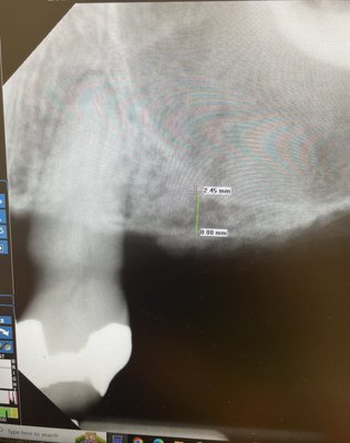Sinus Lift bonegrafting with Dental Implant - Pt. did not have have enough bone for a dental implant due to a pneumatized sinus and lack of bone. A sinus lift was completed along with a dental implant surgery so a tooth can be made on the implant in the future. Sinus Lift bonegrafting with Dental Implant - Pt. did not have have enough bone for a dental implant due to a pneumatized sinus and lack of bone. A sinus lift was completed along with a dental implant surgery so a tooth can be made on the implant in the future.