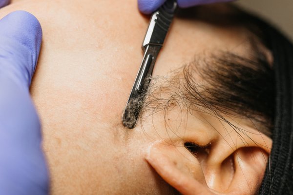 Dermaplaning - Dermaplaning instantly achieves a smooth, polished, and bright complexion by gently removing dead skin and peach fuzz! Dermaplaning - Dermaplaning instantly achieves a smooth, polished, and bright complexion by gently removing dead skin and peach fuzz!
