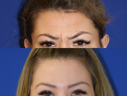 Botox, Daxxify & Dysport - Neurotoxin Before and After Photos Botox, Daxxify & Dysport - Neurotoxin Before and After Photos
