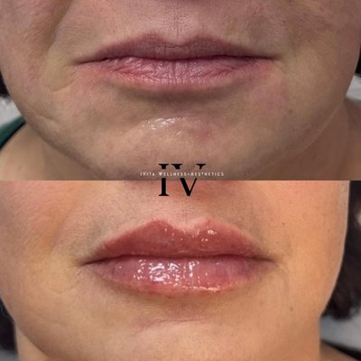 Effortlessly Plump & Naturally Beautiful!💋 1 Syringe,  Perfect Plump Lips!💉 - 💋 Plump, Perfect, and Naturally You! 💋

Achieve beautifully enhanced, natural-looking plum lips with just 1 syringe of filler! 💉✨ Whether you want subtle volume or a more defined pout, our expert injectors at IVita Wellness + Aesthetics will customize your look for soft, kissable, and effortlessly gorgeous lips.

📅 Spots are filling fast! Book your appointment today and let your lips do the talking. 💕

📍 IVita Wellness | Park Ridge, IL
📞 773-234-9607 Call or Text to schedule!