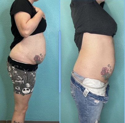 Instasculpting - Instasculpting (Ultrasonic Cavitation) on abdominal region. 
Biweekly sessions done in the span of 3 weeks. Total of 6 sessions.
3 inches off waistline!


Ultrasonic Cavitation body fat reduction, offers a pain-free solution that targets the exact areas you want to reshape instantly. Ultrasound is used to tighten, tone and lift the brow, face and neck – not just skin deep, but deeper into the same fibro-muscular tissues that are typically targeted with surgery. Ultrasound Technology delivers the energy to tighten these structures along with the benefit of producing new collagen that creates added firming power and smoother more supple skin.