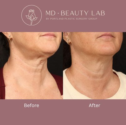 Sculptra - Sculptra Aesthetic is an injectable product that works by stimulating new collagen growth in the deep layers of the skin, resulting in long-lasting improvements to treat deep wrinkles and loss of volume in the cheeks, temples, and other areas of the face.