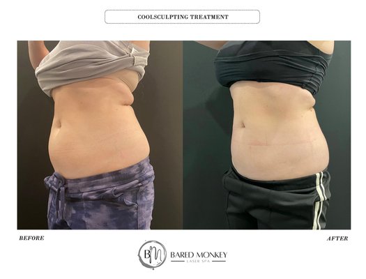 CoolSculpting Body Contouring - Most Effective treatment for fat reduction in the market combine with our most experienced the technician to delivery the best results in the most comfortable way. CoolSculpting Body Contouring - Most Effective treatment for fat reduction in the market combine with our most experienced the technician to delivery the best results in the most comfortable way.
