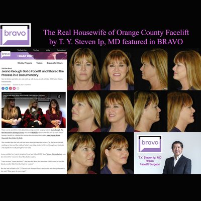 The Real Housewife of Orange County - Jeanna Keough Facelift by T. Y. Steven Ip, MD - T. Y. Steven Ip, MD is renowned for natural beautiful facelift and facial rejuvenation. The original Real Housewife of Orange County Jeanna Keough had her facelift performed by T. Y. Steven Ip, MD. The whole surgical process from pre-op to surgery to her recovery was filmed by PEOPLE TV. All of the entertainment media outlets covered this story of the surgery done by T. Y. Steven Ip, MD. The media outlets loved the results. The Real Housewife of Orange County - Jeanna Keough Facelift by T. Y. Steven Ip, MD - T. Y. Steven Ip, MD is renowned for natural beautiful facelift and facial rejuvenation. The original Real Housewife of Orange County Jeanna Keough had her facelift performed by T. Y. Steven Ip, MD. The whole surgical process from pre-op to surgery to her recovery was filmed by PEOPLE TV. All of the entertainment media outlets covered this story of the surgery done by T. Y. Steven Ip, MD. The media outlets loved the results.