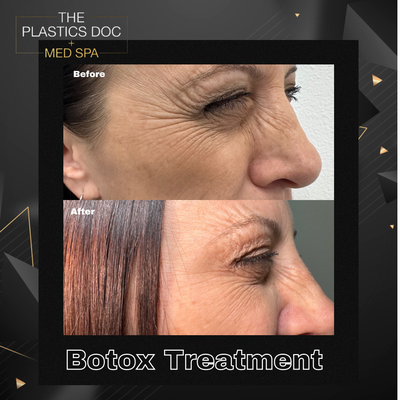 BOTOX INJECTIONS - Botox is an injectable treatment that can temporarily reduce the appearance of wrinkles and fine lines on the face. It works by relaxing the muscles that cause wrinkles, resulting in a smoother, more youthful appearance. The effects of Botox typically last 3-4 months. However, this can vary depending on the individual and the area of the body where it was injected. Repeat injections are usually needed to maintain the desired results.