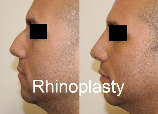 Rhinoplasty - Rhinoplasty procedures can improve the shape and size of your nose to help you look and feel your best.