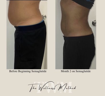 Semaglutide - Semaglutide - Before and After Semaglutide - Semaglutide - Before and After