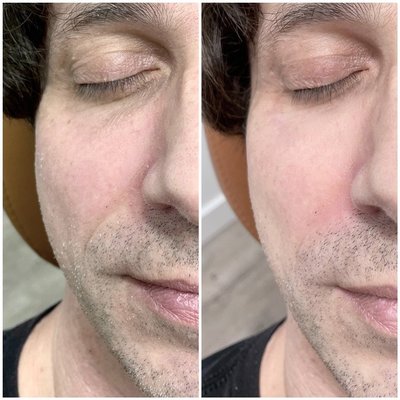 Mid-Face Filler - Mid-Face Filler can be safely done with natural results. Mid-Face Filler - Mid-Face Filler can be safely done with natural results.