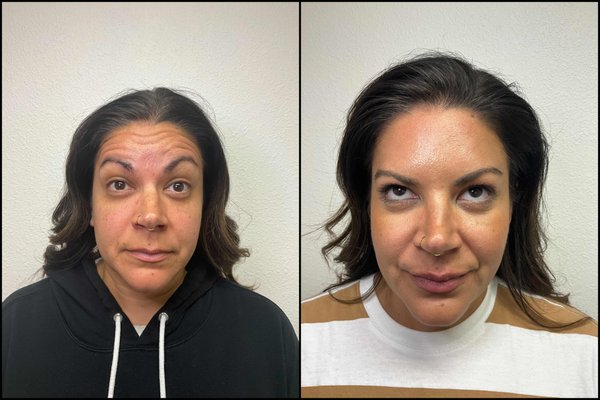 Botox - Smooth, refreshed, and ready to glow ✨ Our expert Botox treatments help you achieve a naturally youthful look—because you deserve to feel as good as you look!