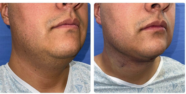 Neck Liposuction - This procedure is great for those in their pre 40's looking to get that beautiful snatched jawline definition and especially for all of you out there not loving that double chin staring back at you on Zoom calls. The procedure itself takes less than an hour and is done awake under local anesthesia. Results are instantly visible. Call us to find out more! Neck Liposuction - This procedure is great for those in their pre 40's looking to get that beautiful snatched jawline definition and especially for all of you out there not loving that double chin staring back at you on Zoom calls. The procedure itself takes less than an hour and is done awake under local anesthesia. Results are instantly visible. Call us to find out more!