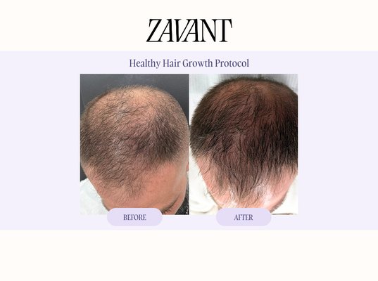 Zavant Healthy Hair Growth Protocol - Explore Zavant Healthy Hair Growth Protocol before & after results at Zavant Aesthetics. This customized hair restoration protocol combines Fotona laser therapy, microneedling, and PRP to support scalp health, stimulate hair follicles, and promote thicker, healthier-looking hair.
Browse real Healthy Hair Growth results to see how this multi-treatment approach is personalized based on each patient’s hair and scalp concerns. Zavant Healthy Hair Growth Protocol - Explore Zavant Healthy Hair Growth Protocol before & after results at Zavant Aesthetics. This customized hair restoration protocol combines Fotona laser therapy, microneedling, and PRP to support scalp health, stimulate hair follicles, and promote thicker, healthier-looking hair.
Browse real Healthy Hair Growth results to see how this multi-treatment approach is personalized based on each patient’s hair and scalp concerns.