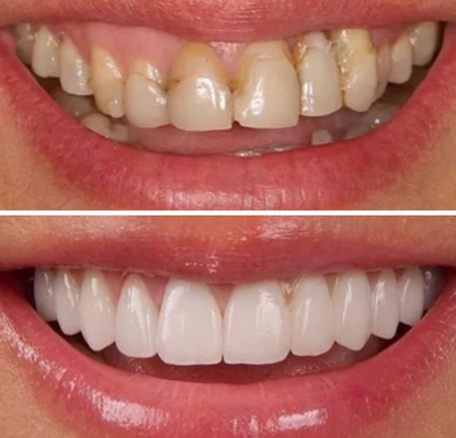 Porcelain veneers/ Dental Veneers - Dental Veneers
Veneers have transformed many smiles by correcting common imperfections. They can improve:
Gaps between teeth
Slight misalignment
Cracks or chips
Stains or discoloration
Minor decay
Worn or uneven teeth
With veneers, you can achieve a brighter, more even, and confident smile.