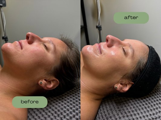 Hydrafacial Deluxe - Before and After One Hydrafacial Deluxe!