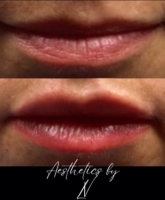 Fillers by Lauren V. - Multiple different projects completed by Lauren V all done with fillers! Book your appointment today! Fillers by Lauren V. - Multiple different projects completed by Lauren V all done with fillers! Book your appointment today!