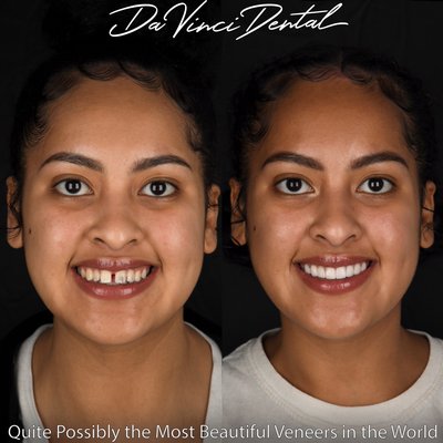 Gain your confidence back! - The dramatic effect cosmetic dentistry can have on someone’s overall look is always surprising. This patient’s beautiful features now flow with each other without disrupting the harmony. Quite possibly the most powerful transformations in cosmetics today are due to Porcelain Veneers. Although plastic surgery and countless other cosmetic procedures have helped many reach their personal goals, they often pale when compared to a world-class Smile Makeover. Look through our pictures on our profile to see how Veneers can create an entirely new person. As you can see in the photo above....effect speaks for itself. This patient laughs and smile now with a newfound confidence, and is actually very proud of their smile. They will have nothing to hide from this point on. Imagine being able to show more happiness at all times, and how profound of a psychological effect that would have! We are fully aware of the power of the art we do for people. This is precisely why we are obsessed with doing it with world-class quality.