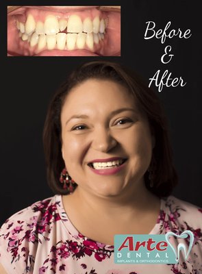Invisalign before and after! - Invisalign before and after! Invisalign before and after! - Invisalign before and after!