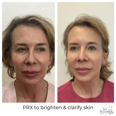 PRX-T33 - Simply put, the biorevitalization peel (PRX-T33) is a skin tightening peel without exfoliation. It is an improved formula of a trichloroacetic acid (TCA) peel. PRX-T33 is a non-peeling peel that was developed as a treatment for children with scars, it is revolutionary for correcting facelift scars, stretch marks, and sagging skin. This is a perfect solution for those who do not want the downtime of a treatment like Fibroblast skin tightening but want similar results.