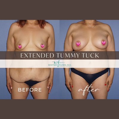 Extended Tummy Tuck - This portfolio showcases a range of before and after results from extended tummy tuck procedures performed by Dr. Whitney Florin. These images highlight patient outcomes at various stages of healing, from 6 weeks to 12 months post-surgery. Extended Tummy Tuck - This portfolio showcases a range of before and after results from extended tummy tuck procedures performed by Dr. Whitney Florin. These images highlight patient outcomes at various stages of healing, from 6 weeks to 12 months post-surgery.