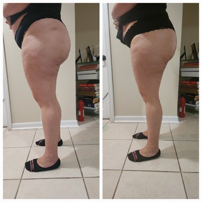 Cellulite treatments - Cellulite forms when fat pushes against connective tissue, causing a dimpled look. I help minimize that appearance by:
Reducing localized fat
Stimulating collagen & elastin
Breaking down fibrous bands (in some treatments)
Smoothing and tightening the skin Cellulite treatments - Cellulite forms when fat pushes against connective tissue, causing a dimpled look. I help minimize that appearance by:
Reducing localized fat
Stimulating collagen & elastin
Breaking down fibrous bands (in some treatments)
Smoothing and tightening the skin