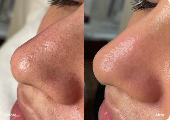 Shrink the appearance of pores - Reduce the Look of Pores

Clear out congested pores to help decrease visible pore size.

100% of participants saw decreased pore size.