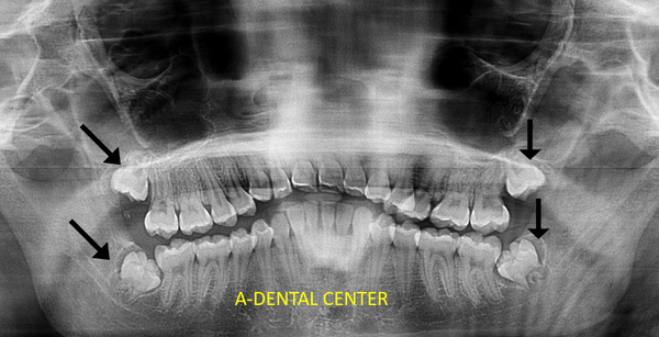 Wisdom Teeth Extraction - Wisdom teeth, also known as third molars, are the last set of molars that typically emerge in a person's late teens or early twenties. Wisdom teeth extraction is one of the common dental procedures we perform at A-Dental Center in which these teeth are removed from the mouth. 

Reasons for Wisdom Teeth Extraction:

    Impaction: Wisdom teeth often don't have enough space to fully emerge and align properly in the mouth. This can lead to impaction, where they get stuck in the jawbone or gum tissue, causing pain, infection, and potential damage to adjacent teeth.

    Pain or Discomfort: Wisdom teeth can cause pain, tenderness, or discomfort in the back of the mouth. This can be due to impaction, inflammation, or infection.

    Misalignment: Wisdom teeth can grow at various angles or in a direction that can affect adjacent teeth or cause bite problems.

    Infection or Gum Disease: Partially erupted wisdom teeth can create pockets in the gum tissue that are difficult to clean, leading to infection or gum disease.

The Wisdom Teeth Extraction Process:

    Consultation: Dr Elzayat will assess the condition of your wisdom teeth, usually through X-rays, and determine if extraction is necessary.

    Recovery: After the procedure, you will be monitored until you are fully awake, especially if you received general anesthesia. You may experience some swelling, bruising, and mild discomfort in the days following the extraction. Pain medication and antibiotics may be prescribed to manage pain and prevent infection.

    Healing: Healing time can vary, but most people recover within a few days to a couple of weeks. You should follow post-operative instructions provided by our office, which typically include instructions on oral hygiene, diet, and activity restrictions.

Potential Complications: While wisdom teeth extraction is generally a straightforward procedure, there can be complications, such as infection, dry socket (a painful condition that can occur if the blood clot in the extraction site dislodges), and nerve damage (rare but possible, particularly with lower wisdom teeth).
Early evaluation and timely extraction can help prevent potential issues and discomfort associated with wisdom teeth.

Call our Office or Schedule a Consultation online