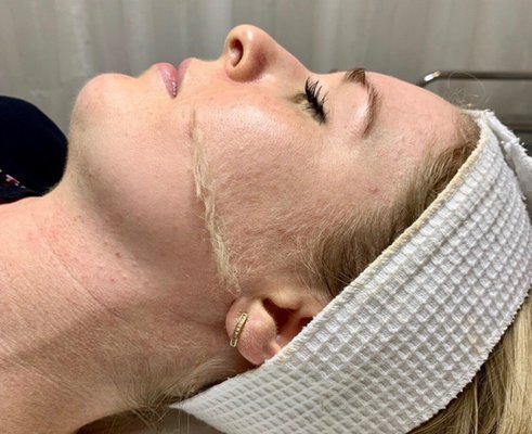 Dermaplane. - The dermaplane facial is an exfoliation treatment that involves gently scraping the face with a medical-grade scalpel to remove the very top layer of skin. The shave removes both dead skin cells and the fine vellus hairs that are known as peach fuzz leaving you with healthy glowing skin. Dermaplane. - The dermaplane facial is an exfoliation treatment that involves gently scraping the face with a medical-grade scalpel to remove the very top layer of skin. The shave removes both dead skin cells and the fine vellus hairs that are known as peach fuzz leaving you with healthy glowing skin.