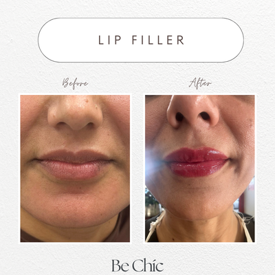 Dermal Fillers - Embracing your natural beauty with a touch of artistry ✨✨ Dermal fillers for that extra glow-up! 💉💋 Dermal Fillers - Embracing your natural beauty with a touch of artistry ✨✨ Dermal fillers for that extra glow-up! 💉💋