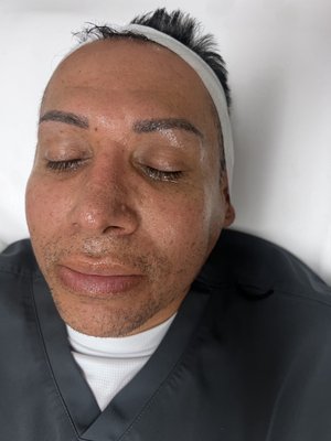 Microneedling - This is a client who has large pores and acne scarring. So far we ended up doing 3 Microneedling treatment a month a part each treatment.