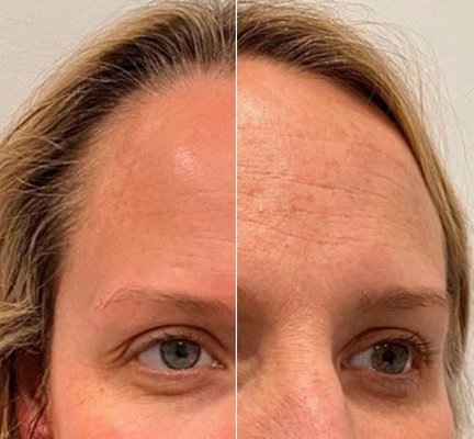 HydraFacial - BENEFITS OF OUR HYDRAFACIAL® TREATMENTS
Preserve a youthful complexion
Maintains skin’s elasticity and brightness
Smooth texture and even out skin tone
Improves the appearance of aging
Supports collagen production and skin turnover
Activates your skin’s ability to calm & repair itself.
Our Classic HydraFacial treatment is not your everyday facial, it’s patented system features a 4-step process that detoxifies, exfoliates and redefines your skin texture and tone, it creates a smooth, glass-like glow while rehydrating and protecting your skin.
Hydrafacial removes impurities from your pores, deeply cleanses, and infuses your skin with rich antioxidants, hyaluronic acid, peptides and other essential nutrients.
The result? Youthful and radiant skin with increased collagen production. This facial is designed for all skin types. HydraFacial - BENEFITS OF OUR HYDRAFACIAL® TREATMENTS
Preserve a youthful complexion
Maintains skin’s elasticity and brightness
Smooth texture and even out skin tone
Improves the appearance of aging
Supports collagen production and skin turnover
Activates your skin’s ability to calm & repair itself.
Our Classic HydraFacial treatment is not your everyday facial, it’s patented system features a 4-step process that detoxifies, exfoliates and redefines your skin texture and tone, it creates a smooth, glass-like glow while rehydrating and protecting your skin.
Hydrafacial removes impurities from your pores, deeply cleanses, and infuses your skin with rich antioxidants, hyaluronic acid, peptides and other essential nutrients.
The result? Youthful and radiant skin with increased collagen production. This facial is designed for all skin types.