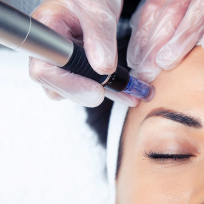 Microneedling - Revitalizing your skin has never been more achievable.
Are you yearning for a youthful glow and a clear complexion? Microneedling harnesses your skin’s natural repair process by creating micro-injuries that stimulate collagen and elastin production. The results are astounding: reduced fine lines, softened wrinkles, and a firmer, more even complexion. It’s the secret weapon is your skins own healing process for picture-perfect skin. Microneedling - Revitalizing your skin has never been more achievable.
Are you yearning for a youthful glow and a clear complexion? Microneedling harnesses your skin’s natural repair process by creating micro-injuries that stimulate collagen and elastin production. The results are astounding: reduced fine lines, softened wrinkles, and a firmer, more even complexion. It’s the secret weapon is your skins own healing process for picture-perfect skin.