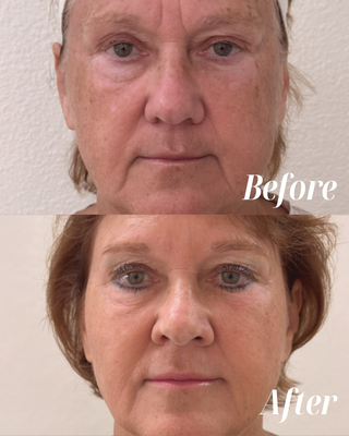 Facial Rejuvenation - Dr. Shadi creates customized facial rejuvenation packages personalized to your unique needs and concerns for the most stunning results. Whether you’re looking to smooth fine lines, restore volume, or brighten your complexion, our tailored approach helps you look younger, refreshed, and effortlessly radiant. At Dr. Shadi Concierge MedSpa, we’re dedicated to enhancing your natural beauty, so you leave feeling confident and glowing from the inside out. Facial Rejuvenation - Dr. Shadi creates customized facial rejuvenation packages personalized to your unique needs and concerns for the most stunning results. Whether you’re looking to smooth fine lines, restore volume, or brighten your complexion, our tailored approach helps you look younger, refreshed, and effortlessly radiant. At Dr. Shadi Concierge MedSpa, we’re dedicated to enhancing your natural beauty, so you leave feeling confident and glowing from the inside out.