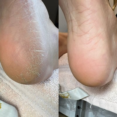 Callus removal - Podiatrists, your go-to foot medical professionals and the North American School of Podology who trains medical pedicurists recommend dry pedicures as the healthiest way to a pedicure and produces the best results.
Your health is important, and despite the disinfectants used in the pedicure foot tanks, your feet are still more prone to germs, easily transmitted fungus and other contagious diseases when you soak on the throne. Contrary to popular belief wet skin distorts the skin a makes it more difficult to accurately remove calluses and dead skin.
You’ll achieve truly soft and smooth skin through a dry pedicure.
Many of us look forward to our pedicure getting rid of hard skin and calluses. Calluses tend to reform every 4-6 weeks.
The result is more comfort and less frequent callus build-up. more. Of course, your feet will look better too Callus removal - Podiatrists, your go-to foot medical professionals and the North American School of Podology who trains medical pedicurists recommend dry pedicures as the healthiest way to a pedicure and produces the best results.
Your health is important, and despite the disinfectants used in the pedicure foot tanks, your feet are still more prone to germs, easily transmitted fungus and other contagious diseases when you soak on the throne. Contrary to popular belief wet skin distorts the skin a makes it more difficult to accurately remove calluses and dead skin.
You’ll achieve truly soft and smooth skin through a dry pedicure.
Many of us look forward to our pedicure getting rid of hard skin and calluses. Calluses tend to reform every 4-6 weeks.
The result is more comfort and less frequent callus build-up. more. Of course, your feet will look better too