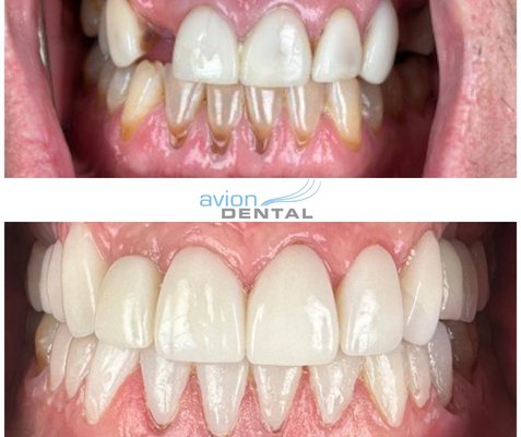 Zirconia Crowns Chino Hills CA - Zirconia Crowns (Tooth-Colored, Metal-Free) — Chino Hills, CA

Project Overview
Need to fix a cracked, worn, or root-canal tooth? Avion Dental in Chino Hills, CA creates custom zirconia crowns that look natural and stand up to everyday chewing. We use digital 3D scans (no gooey impressions), precise shade matching, and gentle anesthesia for a quick, comfortable visit.

Best For

Large cavities or fractures

Post–root canal protection

Replacing old metal/failing crowns

Cosmetic upgrade for discolored or misshapen teeth

What’s Included

Comfort-first exam & X-rays

Intraoral digital scan and shade match

Custom zirconia crown design

Cementation and bite adjustment

Home-care guidance + follow-up check

Why Zirconia?

Metal-free & biocompatible

Exceptional strength (great for molars)

Lifelike, tooth-colored aesthetics (no dark line at the gums)

Stain-resistant and long-lasting with routine care

Why Choose Avion Dental

Local Chino Hills team led by Dr. Kim

Advanced tech; same-day solutions available for select cases

Transparent pricing, PPO-friendly, and flexible financing

Friendly, professional staff; great communication and gentle care

Typical Timeline

Visit 1: Exam, X-rays, digital scan, prep (temporary if needed)

Fabrication: Custom crown crafted to your bite and smile line

Visit 2: Fit, cement, and bite fine-tune (often 1–2 weeks later)
Ask about same-day options when clinically appropriate.

What We Need to Give an Accurate Quote

Which tooth is involved (front/back, upper/lower)

Any pain/sensitivity or previous treatment (e.g., root canal)

Insurance provider (if any)

Recent X-rays (optional—helpful if you have them)

After-Care
Brush and floss daily, avoid very sticky/hard foods for 24 hours after placement, wear a nightguard if you clench, and keep regular cleanings. With good care, zirconia crowns commonly last 10–15+ years.

Service Area
Chino Hills • Chino • Diamond Bar • Brea • Yorba Linda • Pomona • Eastvale • Corona

FAQs
How long does a zirconia crown last? With routine checkups and good home care, 10–15+ years is common.
Will it match my teeth? Yes. We custom shade-match and polish for a natural, seamless look.
Is it better than porcelain-fused-to-metal? For many back teeth, zirconia offers superior strength and no metal line. We’ll help you choose the best option.
Does insurance cover crowns? Many PPO plans cover a portion. We’ll verify benefits and provide a clear estimate.
Can I get a crown in one day? Often, yes—depending on tooth location and complexity.


Zirconia Crowns Chino Hills, Dental Crowns Chino Hills, Metal-Free Crowns, Same-Day Crowns, Tooth-Colored Crowns, Crown After Root Canal, Cracked Tooth Repair, Cosmetic Dentist Chino Hills, Family Dentist Chino Hills