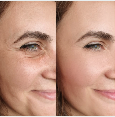 Botox Before And After - Botox/Dysport offers predictable results to reduce fine lines and wrinkles, enriching your appearance while ensuring a natural, refreshed look. It’s a perfect solution for those looking to rejuvenate and enhance their facial features. Clients seeking relief from issues like hyperhidrosis (excessive sweating), migraine headaches, or TMJ (temporomandibular joint) pain due to jaw clenching can also benefit from Botox/Dysport treatments. Discover the confidence-boosting benefits of Botox/Dysport at Enriched Aesthetics in Morristown, NJ. Book your consultation today and explore how Botox/Dysport can help you achieve a rejuvenated, naturally refreshed look. Botox Before And After - Botox/Dysport offers predictable results to reduce fine lines and wrinkles, enriching your appearance while ensuring a natural, refreshed look. It’s a perfect solution for those looking to rejuvenate and enhance their facial features. Clients seeking relief from issues like hyperhidrosis (excessive sweating), migraine headaches, or TMJ (temporomandibular joint) pain due to jaw clenching can also benefit from Botox/Dysport treatments. Discover the confidence-boosting benefits of Botox/Dysport at Enriched Aesthetics in Morristown, NJ. Book your consultation today and explore how Botox/Dysport can help you achieve a rejuvenated, naturally refreshed look.