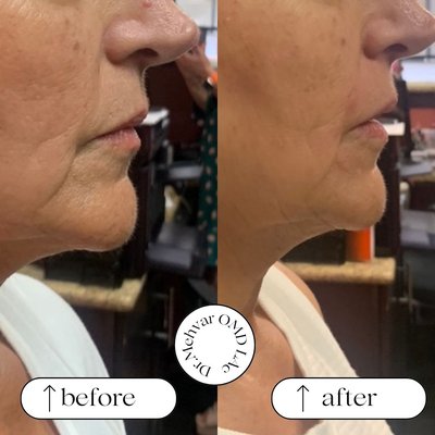 Before and After Photos - Weight Loss and Cosmetic Acupuncture by Dr. Mehvar, Lac, OMD