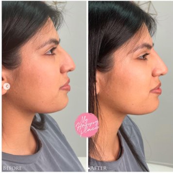 Non-surgical rhinoplasty (nose job)....with hyaluronic acid. I charge $800 for this procedure. - First of all...can we talk about how naturally gorgeous she is?! She just wanted her nose to have a softer smoother profile. I did a non-surgical rhinoplasty (nose job) with filler to give her this beautiful result. Non-surgical rhinoplasty (nose job)....with hyaluronic acid. I charge $800 for this procedure. - First of all...can we talk about how naturally gorgeous she is?! She just wanted her nose to have a softer smoother profile. I did a non-surgical rhinoplasty (nose job) with filler to give her this beautiful result.