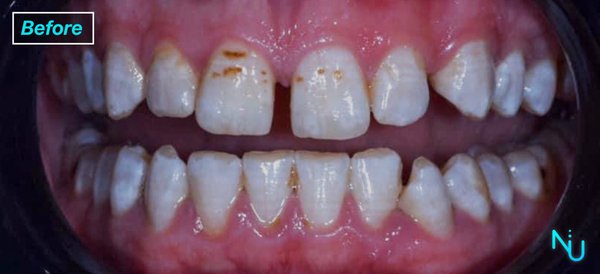 Veneers 1 - Before and After Images of Porcelain Veneers Placed at Nu Dentistry.