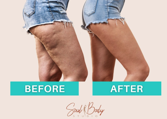 Cellulite - Soul Body Studio is dedicated to sculpting the body you’ve always wanted. We will reduce fat in unwanted areas, tone and define your body and face. Our non-surgical, low-level laser procedures are proven to safely shrink fat cells in any area you choose to target. Allowing you to tone, define, and sculpt your waist, thighs, calves and stomach. We also specialize in reducing the appearance of cellulite. Our method is painless and requires no surgery, no downtime and is a much safer and healthier alternative.
Call us today for a free consultation! Cellulite - Soul Body Studio is dedicated to sculpting the body you’ve always wanted. We will reduce fat in unwanted areas, tone and define your body and face. Our non-surgical, low-level laser procedures are proven to safely shrink fat cells in any area you choose to target. Allowing you to tone, define, and sculpt your waist, thighs, calves and stomach. We also specialize in reducing the appearance of cellulite. Our method is painless and requires no surgery, no downtime and is a much safer and healthier alternative.
Call us today for a free consultation!