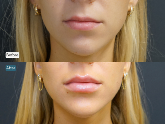 Hyaluronic Acid Fillers - Smooth, contour, and plump with the industry's leading hyaluronic fillers from JUVÉDERM®, Restylane®, and Revance®. Hyaluronic Acid Fillers - Smooth, contour, and plump with the industry's leading hyaluronic fillers from JUVÉDERM®, Restylane®, and Revance®.