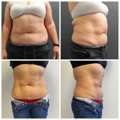 Cryoskin - Fat Freezing Before & After - Consists of a three-phase thermal shock that can naturally destroy fat cells. If you’re looking to lose fat on your thighs, stomach, and arms or back quickly and painlessly, this is the solution for you. A typical CryoSkin slimming treatment lasts for 28 minutes. Cryoskin - Fat Freezing Before & After - Consists of a three-phase thermal shock that can naturally destroy fat cells. If you’re looking to lose fat on your thighs, stomach, and arms or back quickly and painlessly, this is the solution for you. A typical CryoSkin slimming treatment lasts for 28 minutes.