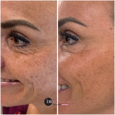 Neurotoxins - Neurotoxins (Botox, Dysport, and Jeuveau) are used to smooth wrinkles or facial lines that appear with expressions. Facial lines appear over time due to repeated muscle contractions from frowning, squinting, or raising eyebrows. These neuromodulators block the signals to small facial muscles, giving you a smoother appearance. Botox is FDA-approved to treat multiple areas of the face. Neurotoxins - Neurotoxins (Botox, Dysport, and Jeuveau) are used to smooth wrinkles or facial lines that appear with expressions. Facial lines appear over time due to repeated muscle contractions from frowning, squinting, or raising eyebrows. These neuromodulators block the signals to small facial muscles, giving you a smoother appearance. Botox is FDA-approved to treat multiple areas of the face.