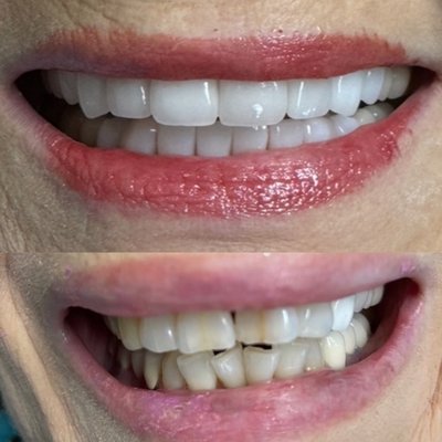 Before and After - This patient wanted a bright smile with straight teeth, it took 3 visits and 3 weeks to make her custom lab made zirconia crowns! She was very happy with her new smile! Before and After - This patient wanted a bright smile with straight teeth, it took 3 visits and 3 weeks to make her custom lab made zirconia crowns! She was very happy with her new smile!