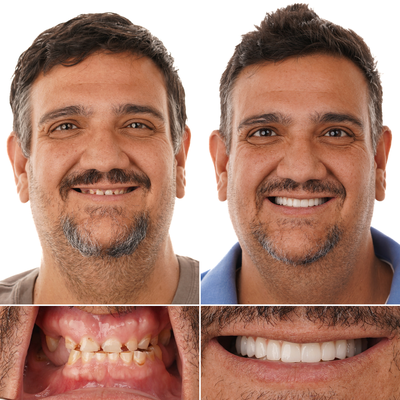 Joey's All-on-4 Dental Implant Journey - Joey’s smile has been completely transformed with dental implants. His upper teeth were broken and severely worn down, making it hard to smile or eat comfortably. Now, with a full arch restoration, he finally has the confident, natural-looking smile he deserves.