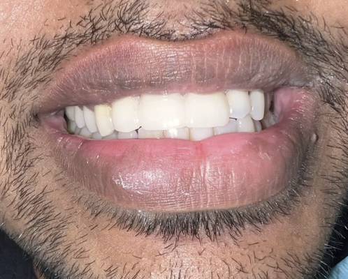 General Dentistry - We are happy to help with any dental work that you need including fillings, crowns, root canals, nightguards/splints, deep cleanings, and bridges. If you don't see something on the list, please don't hesitate to call and ask. General Dentistry - We are happy to help with any dental work that you need including fillings, crowns, root canals, nightguards/splints, deep cleanings, and bridges. If you don't see something on the list, please don't hesitate to call and ask.