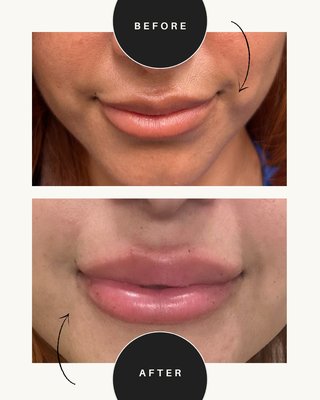 Lip Filler Before and Afters - Some of the luscious lips we've done! Lip Filler Before and Afters - Some of the luscious lips we've done!