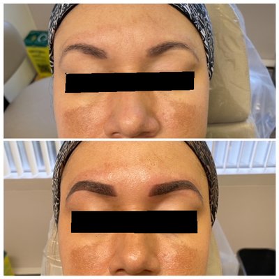 Powder Brows - Firstly- The Consultation
In the consultation and on the same day but just prior to your eyebrow procedure, we discuss the end result you want for your new eyebrows.
Example:
What she wants:
Her new dream brow is a dark brown eyebrow that is more thick in shape, soft and powdery looking that is symmetrical and matches her bone structure and facial features.
Problems with previous eyebrow tattoo:
1. Blotchy in colour; jagged borders;
2. Tail is too low and too long;
3. Colour tone is bad - too purple; and
4. Shape is poor - not symmetrical with opposite brow, too round in shape.
Secondly - Measuring, and mapping with grid line
1. A grid line is drawn to ensure new brows are drawn on symmetrical.
2. Her left eyebrow is too low and in order to correct this problem, her left brow needs to be raised to the top of the grid line.
3. Both tails are too low. They both fall below the lowest grid line.
Thirdly- The Pre draw and Design
A new eyebrow shape is created and drawn on with an eyebrow pencil to show the client the new shape. The new design is created in accordance with each clients facial measurements and bone structure so the new brows match each clients face shape so the final result is a natural looking eyebrow.
Fourthly - The end result!
Final result! Our happy client now has beautiful natural looking dark brow brows that are symmetrical! Powder Brows - Firstly- The Consultation
In the consultation and on the same day but just prior to your eyebrow procedure, we discuss the end result you want for your new eyebrows.
Example:
What she wants:
Her new dream brow is a dark brown eyebrow that is more thick in shape, soft and powdery looking that is symmetrical and matches her bone structure and facial features.
Problems with previous eyebrow tattoo:
1. Blotchy in colour; jagged borders;
2. Tail is too low and too long;
3. Colour tone is bad - too purple; and
4. Shape is poor - not symmetrical with opposite brow, too round in shape.
Secondly - Measuring, and mapping with grid line
1. A grid line is drawn to ensure new brows are drawn on symmetrical.
2. Her left eyebrow is too low and in order to correct this problem, her left brow needs to be raised to the top of the grid line.
3. Both tails are too low. They both fall below the lowest grid line.
Thirdly- The Pre draw and Design
A new eyebrow shape is created and drawn on with an eyebrow pencil to show the client the new shape. The new design is created in accordance with each clients facial measurements and bone structure so the new brows match each clients face shape so the final result is a natural looking eyebrow.
Fourthly - The end result!
Final result! Our happy client now has beautiful natural looking dark brow brows that are symmetrical!